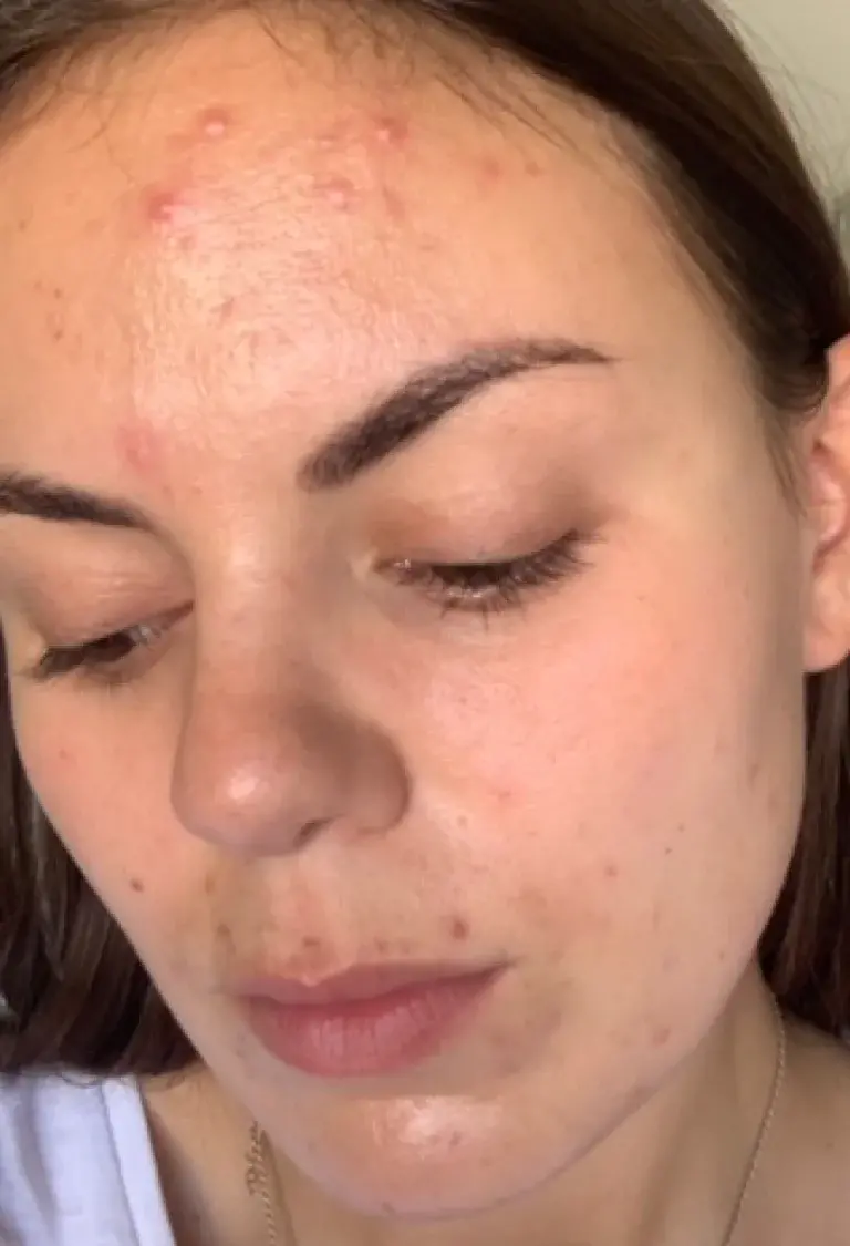 Before treatment